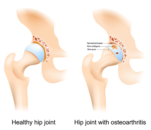 A diagram of a hip joint