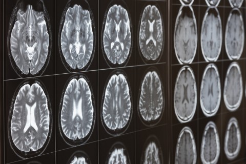 Spotting the Warning Signs of Stroke Critical for Successful Treatment